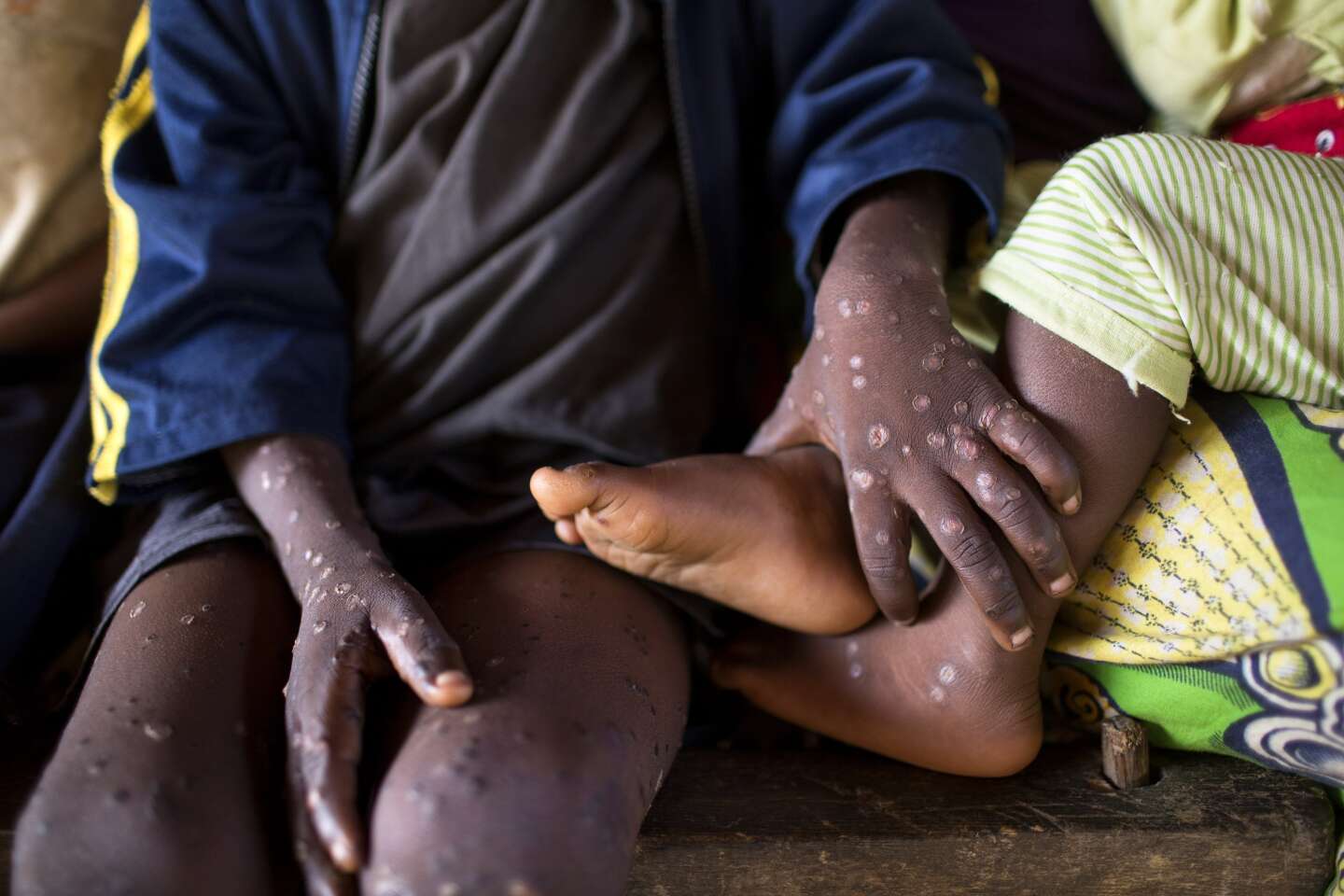 Epidémie de variole du singe: la Guinée enregistre son premier cas confirmé