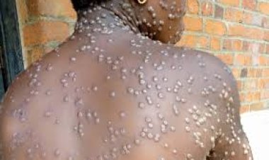 Flambée de variole en Afrique, l'OMS déclare une "urgence de santé internationale"