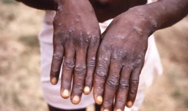 Variole du singe/Mpox : Le ministre de la Santé rassure la population face à l’urgence sanitaire