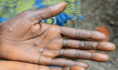 Épidémie de variole du singe en Côte d'Ivoire : 32 cas confirmés, dont un décès, 272 contacts sous surveillance (Ministère de la Santé)