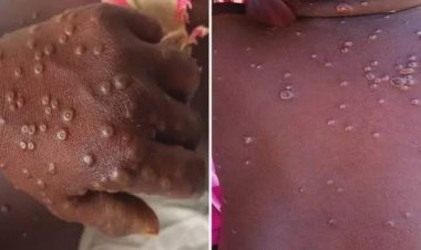 Guinée : l'ANSS annonce une dizaine de cas suspects de variole du singe