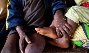 Variole du singe en Afrique : 135 millions de dollars pour enrayer l'épidémie (OMS)