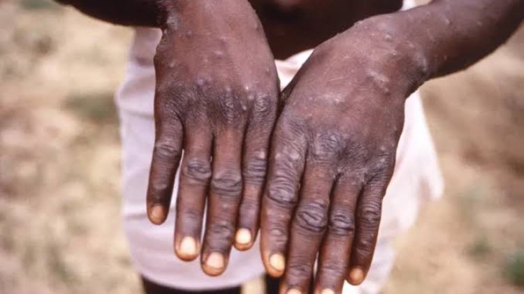 Variole du singe/Mpox : Le ministre de la Santé rassure la population face à l’urgence sanitaire