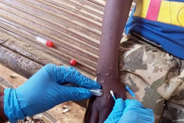 Migrants vulnérables à la MPOX en Afrique : l’OIM demande 18,5 millions de dollars pour soutenir la réponse