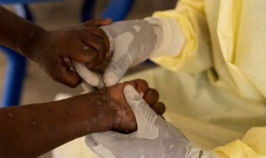 Épidémie de variole du singe en Afrique : La Guinée enregistre son premier cas confirmé