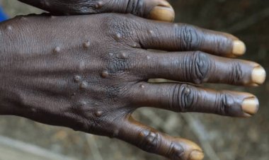 La variole du singe en Guinée : les recommandations du directeur préfectoral de la santé de Kankan