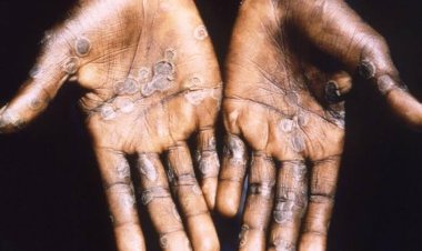 L'UNHCR sollicite plus de 21 millions de dollars pour prévenir la variole du singe chez les réfugiés en Afrique