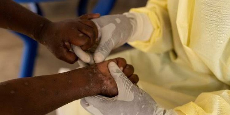 Épidémie de variole du singe en Afrique : La Guinée enregistre son premier cas confirmé