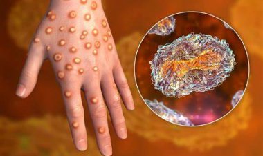 Mpox en Guinée : l'État sur le pied de guerre face à la résurgence du virus