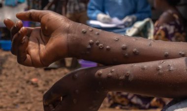 Guinée : plusieurs districts enfin débarrassés de la mpox, de la dengue et de la fièvre de Lassa