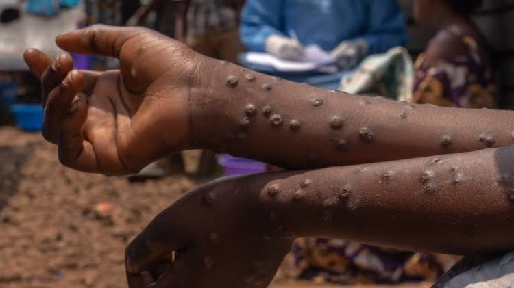Guinée : plusieurs districts enfin débarrassés de la mpox, de la dengue et de la fièvre de Lassa